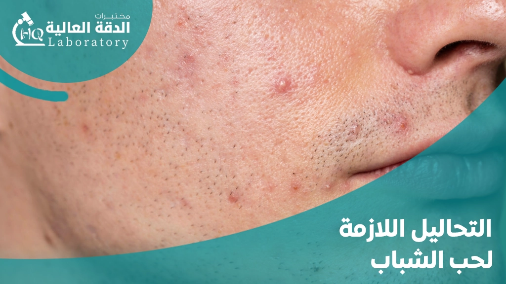 التحاليل اللازمة لحب الشباب